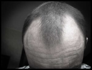 hair transplant